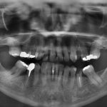 Dental x-Rays - Everything You Need to Know