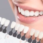 Benefits of Professional Teeth Whitening v/s OTC Whitening