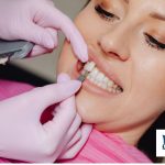 Ideal Candidates for Veneers